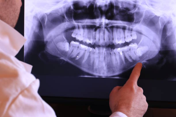 Best Emergency Wisdom Teeth Removal in Homer Glen, IL