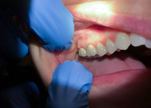 Best Emergency Dental Care for Broken or Chipped Teeth in Homer Glen, IL